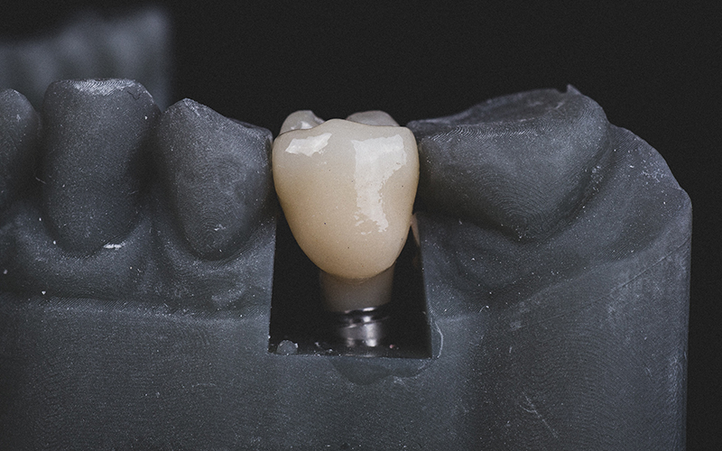 蒲田のインプラント専門医院、のびのび歯科・矯正歯科