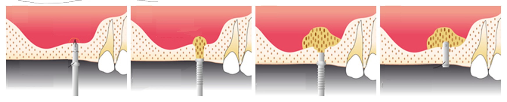 蒲田のインプラント専門医院、のびのび歯科・矯正歯科 でインプラント治療のための骨造成